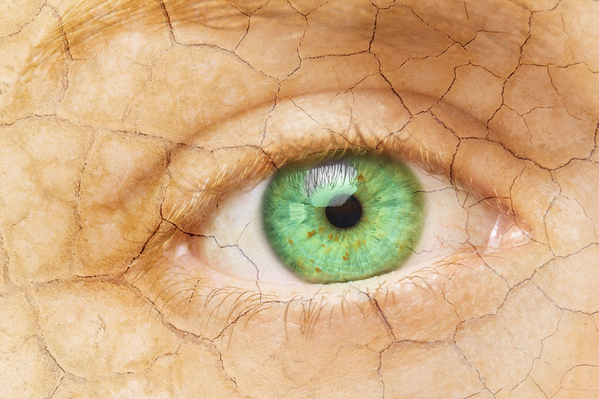 Common Symptoms of Dry Eye Disease